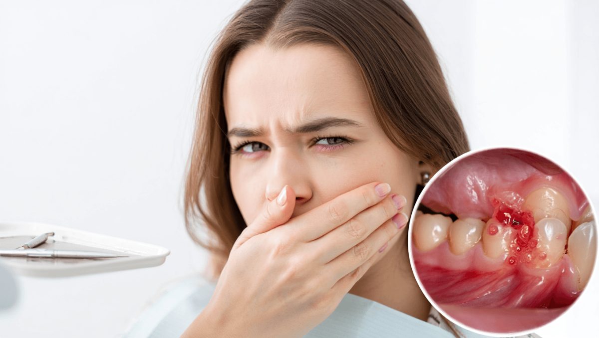 Die Stabilisierung von Gingivagewebe reduziert die Entzündung