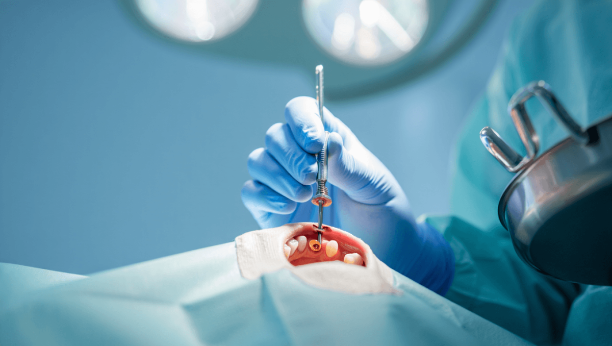 Vollwertige schmale Implantate BioniQ® mit Ø 2,9mm: stabil und prothetisch vielseitig