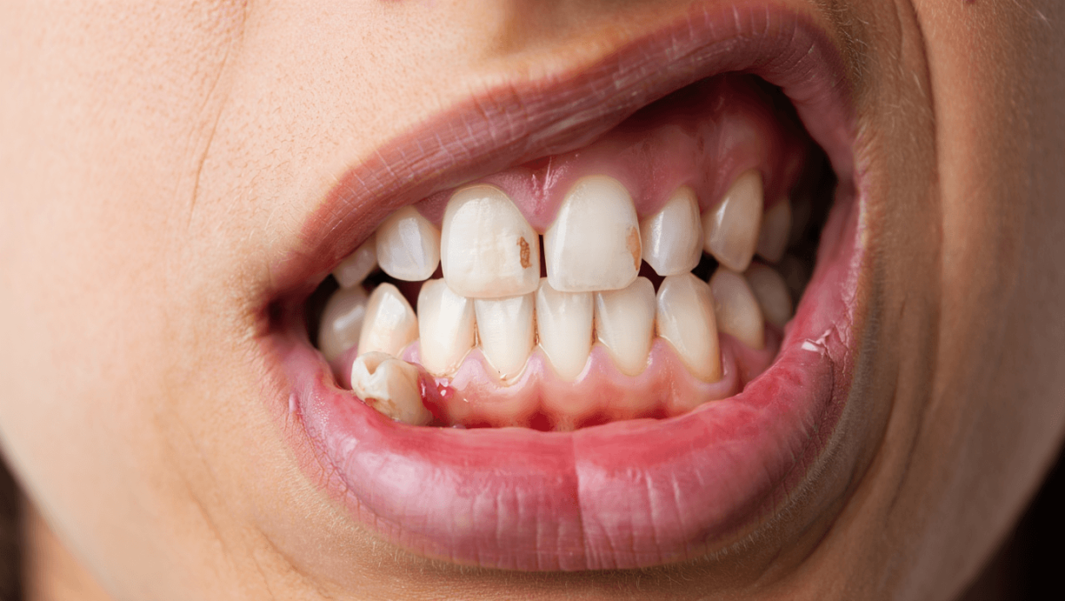 Dentinhypersensibilität: Was Knochen heilen soll, könnte auch empfindliche Zähne schützen