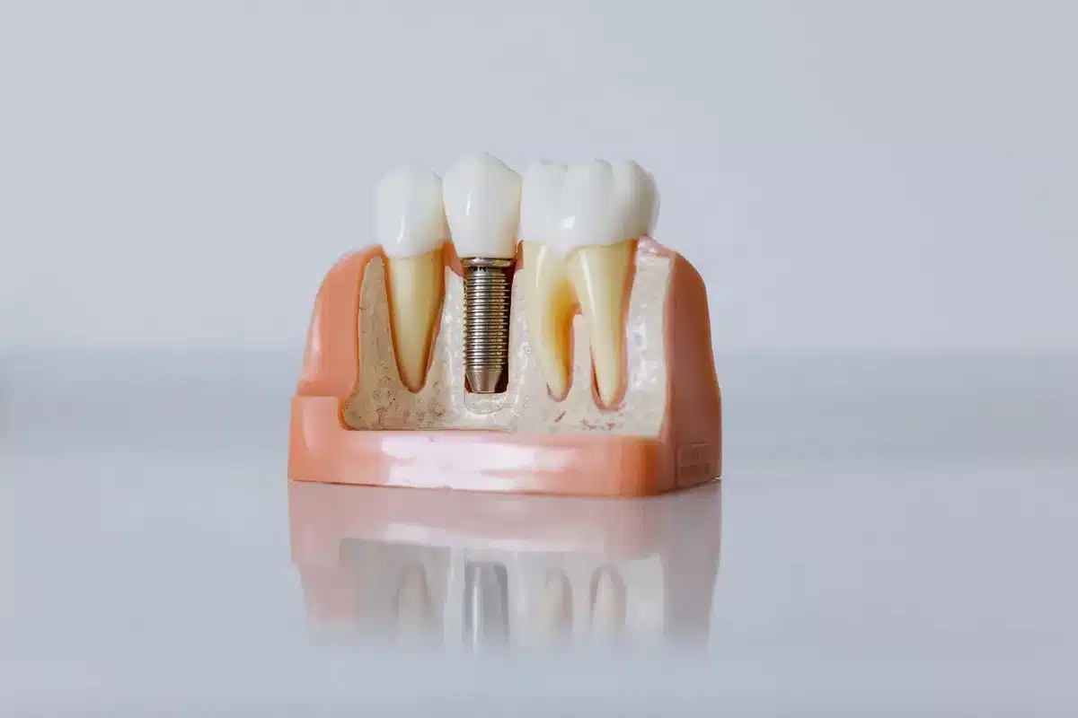 Weichgewebsvorbereitung und Gingivaformung rund um ein Zahnimplantat