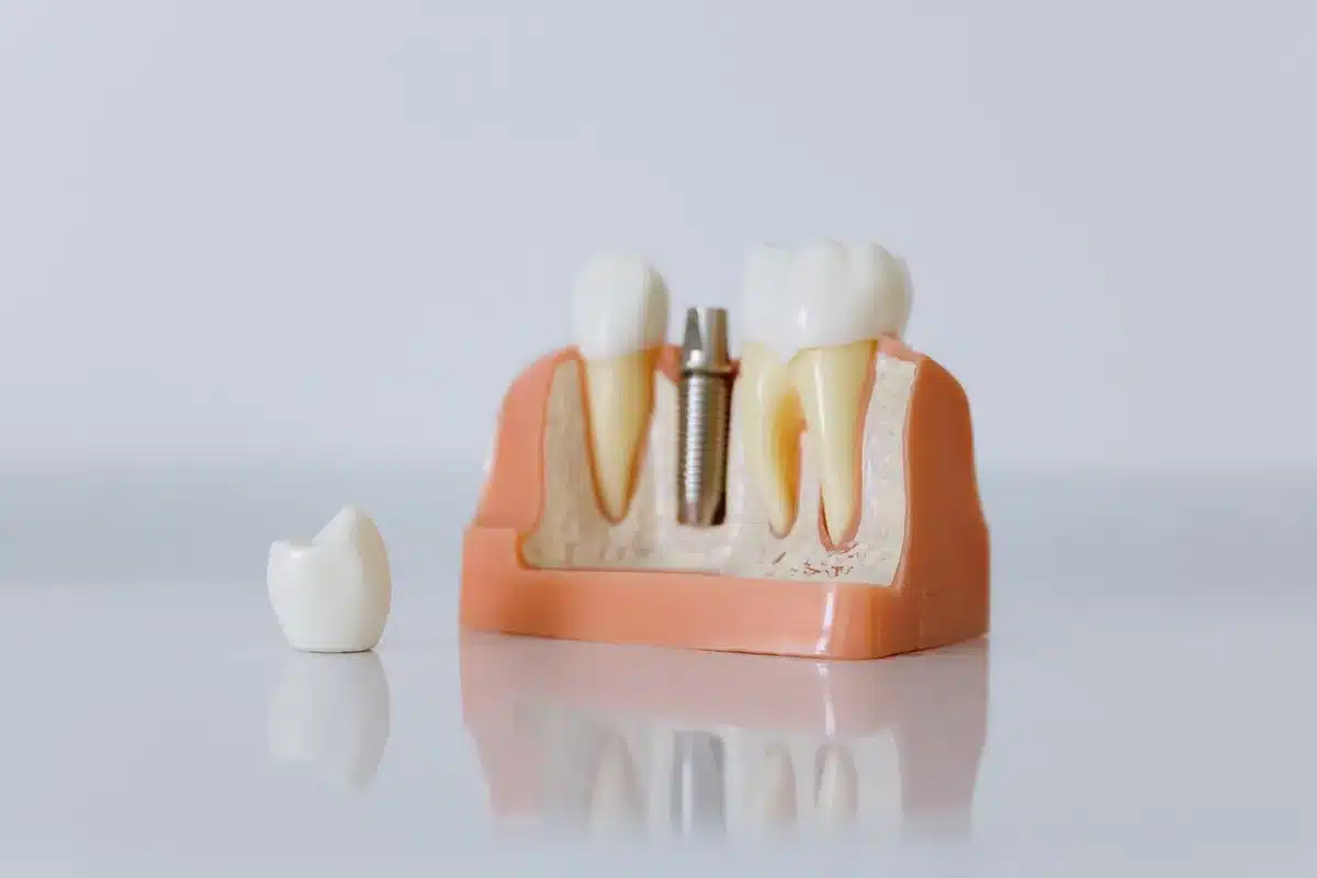 Zahnärztliche Hände halten ein Zahnmodell neben einem Computerbildschirm mit 3D-Implantatplanungssoftware