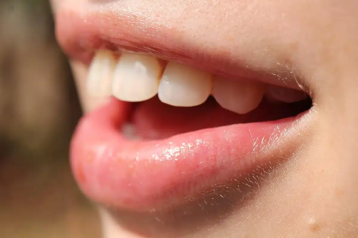 Operationsbereich nach kleiner Gingivektomie mit verheilter Gingiva vor Restaurationsbeginn